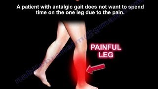 Antalgic Gait  Everything You Need To Know  Dr Nabil Ebraheim [upl. by Rehctaht]