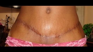 Tummy Tuck Surgery My Journey from Beginning to End [upl. by Nilre]