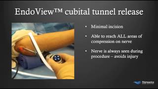 EndoTech® Endoscopic Cubital Tunnel Treatment  Fitzmaurice Hand Institute  Phoenix Arizona [upl. by Witty179]