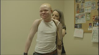 Tanzanian albino children get new limbs in US [upl. by Liag]