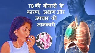 Tuberculosis TB के कारण लक्षण और उपचार – Tuberculosis Causes Symptoms amp Treatment in Hindi [upl. by Elnar]