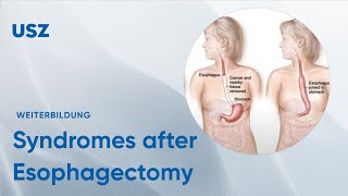 Functional syndromes after Esophagectomy – Please participate in our 3minute survey below [upl. by Nelav]