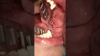 Split Crest Technique with Simultaneous Implant Placement [upl. by Aihsa]