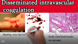 Disseminated intravascular coagulation DIC  Causes Symptoms Treatment and prognosis [upl. by Yajeet]