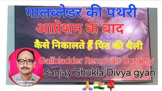 Gallbladder Stones Removed Surgery trending motivation Dr VP Singh Faijabad Ayodhya UP [upl. by Nahtanha]