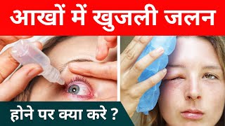 Home Remedies For Burning And Itchy Eyes [upl. by Eineeuq]