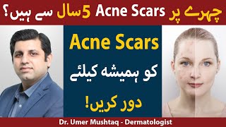 Treatments for ACNE SCARS Kaise Hataye  Acne Scars Removal  How To Remove Acne Scars [upl. by Innavoig359]