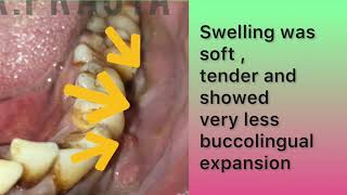 Case 12 odontogenic keratocyst [upl. by Pine]