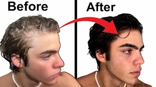 How To Stop Balding  Full hair loss guide [upl. by Niran121]