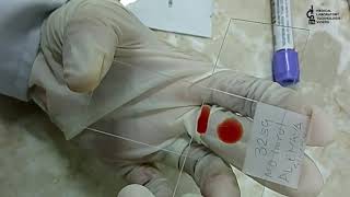 Blood smear preparation2 methods to learnThick amp Thin smear preparation [upl. by Lladnik]