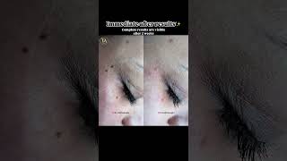 Skin tag removal timelessaesthetics drshikhabaghi [upl. by Marthe]