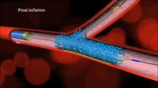 Main Branch Bifurcation Stent quotPROVISIONALquot by Advanced Bifurcation Systems [upl. by Annola755]