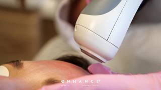 1540 Sublative Fractional Laser Treatment Beverly Hills [upl. by O'Conner]