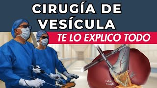 CIRUGÍA DE VESÍCULA  Colecistectomía Laparoscópica  Lo que debes saber [upl. by Derfniw]