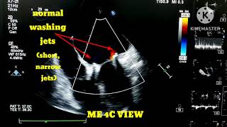 How to differentiate between normal washing jets and paravalvular leak [upl. by Ytinirt]