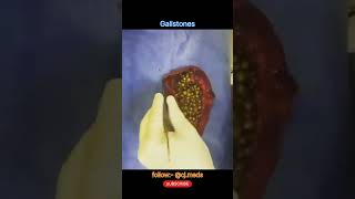 Gallbladder stones  Gallbladder dissection  laparoscopic cholecystectomy [upl. by Gizela173]