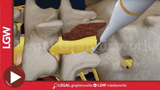 L5S1 Lumbar Discectomy and Fusion Surgery 3D animation [upl. by Ravaj]