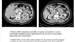 Neoadjuvant therapy [upl. by Frasch]