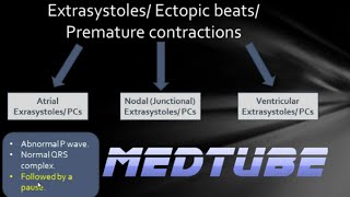 ECGs abnormal rhythms Extrasystoles [upl. by Zielsdorf487]