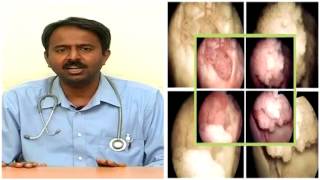 Doctor care  Bladder Cancer Symptoms And Treatment Part 1 [upl. by New]