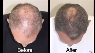 Hair Loss Treatment for Men with Advanced Trichology [upl. by Bainter]