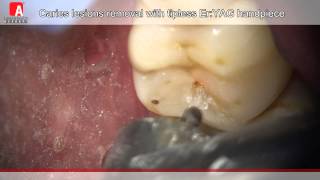 Caries Removal amp Cavity Preperation with Fotona Lightwalker ErYAG Laser [upl. by Rollin]