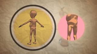 Child Malnutrition  What How And when to Refer [upl. by Moule472]