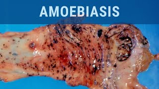 Amoebiasis  Pathology mini tutorial [upl. by Aivatnahs]