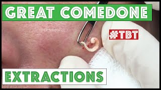 Greatest Blackheads and Whiteheads TBT [upl. by Ardnoik]