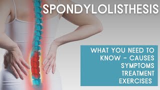 What you need to know about SPONDYLOLISTHESIS causes symptoms treatment exercises [upl. by Iphigenia240]