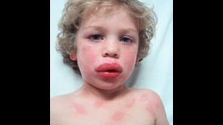 Anaphylaxis and Acute Allergic reaction  How to Help [upl. by Ottilie92]