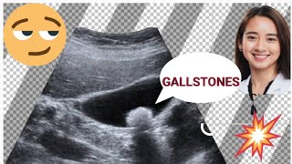 Gallstones sign symptoms l Asymptomatic gallstones l 🔥🔥😟 [upl. by Yerak]