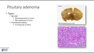 Brain Pituitary adenoma [upl. by Cox]