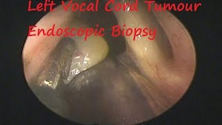 Laryngology  Left Vocal Cord Tumour Endoscopic Biopsy [upl. by Whitcher]