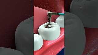 Thats how they fix your tooth cavity pain free [upl. by Codd]