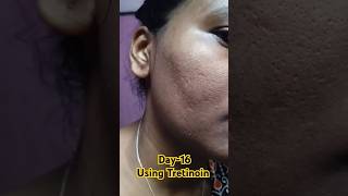 Day16 Using Tretinoin 0025 cream viralvideo tretinoin shorts youtubeshorts [upl. by Boaten]