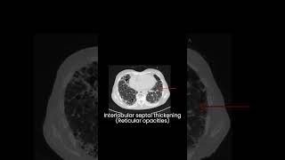 UIP Usual Interstitial pneumonia Idiopathic pulmonary fibrosis l Interstitial lung disease l HRCT [upl. by Laven]