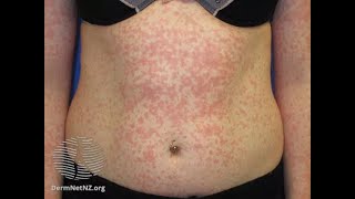 Maculopapular Rash  Causes [upl. by Lowe96]