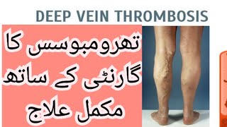 HOW CAN TREAT THROMBOSIS homeopathic treatment  Doctor Abida [upl. by Pry596]