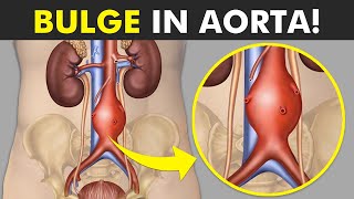 Aortic Aneurysm Explained Symptoms Causes and Treatments [upl. by Brian115]