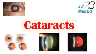 Cataracts  Causes Risk factors Subtypes Cortical Nuclear Posterior subcapsular Treatment [upl. by Kera]