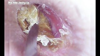 Ear Wax Removal 101 Itching Like Crazy Because Of Big And Thick Earwax  Ear Cleaning ASMR [upl. by Norej]