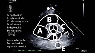 Parasternal short axis view at the level of the aortic valve [upl. by Jez86]