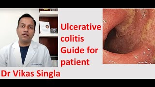 Ulcerative colitis Treatment and Symptoms अल्सरेटिव कोलाइटिस In Hindi Dr Vikas Singla [upl. by Tabshey]