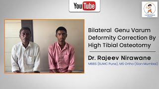 Bilateral Genu Varum Deformity Correction By High Tibial Osteotomy [upl. by Ragse]