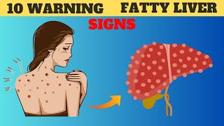 DONT IGNORE These 10 WARNING Signs Of FATTY LIVER Disease [upl. by Yelkao614]