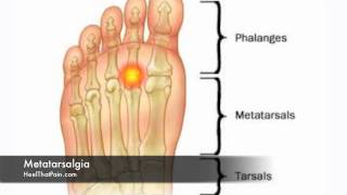 Metatarsalgia Foot Pain Causes Symptoms amp Treatments [upl. by Euginomod]