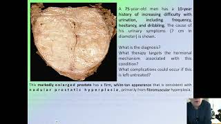 MALE GENITAL SYSTEM DISESES CASES [upl. by Liemaj]