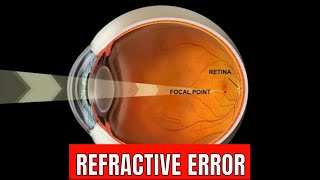 Refractive error Of eye [upl. by Wallace]