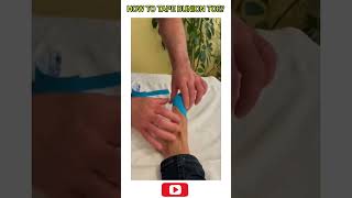 Taping bunion buniontoe bunions buniontreatment bunioncorrector [upl. by Ediva484]